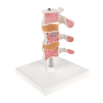 Osteoporosis Luxury Model (Three Vertebrae)